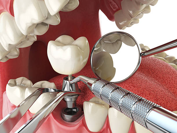 Teeth Whitening in NE